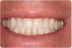 invisalign after photo