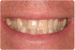 invisalign before photo