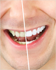teeth-whitening-238x300